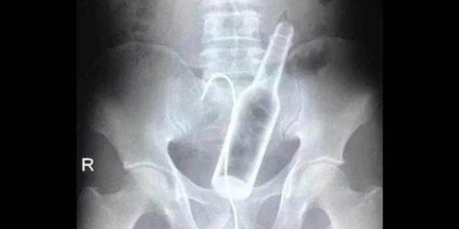 Bêbado, homem introduz garrafa no ânus e passa por cirurgia