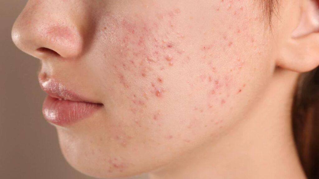 Acne: Tratamento e erros comuns no cuidado da pele