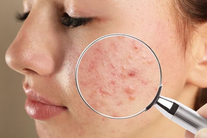 Acne: Tratamento e erros comuns no cuidado da pele